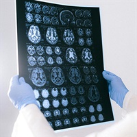 Brain Scan Alzheimer's Not Found